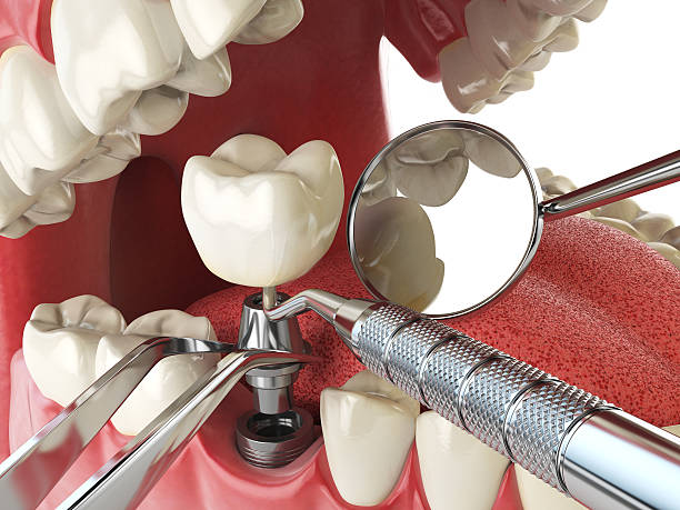 Best Emergency Treatment for Dental Infections or Abscesses in Strasburg, CO